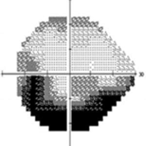 How to interpret visual fields: 5 most common patterns.